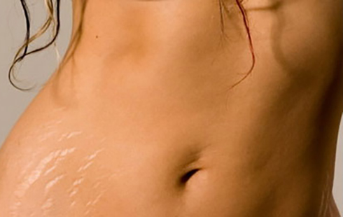 stretch_marks